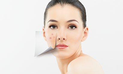 Acne & Scar Reduction