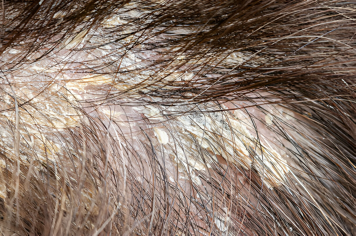 Dandruff and Seborrheic Dermatitis