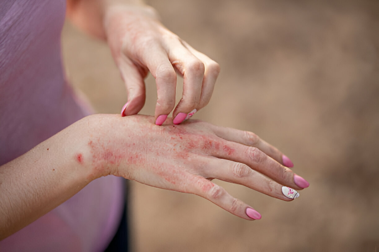 Eczema