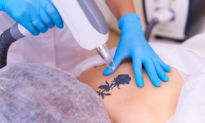 tattoo-removal-treatment