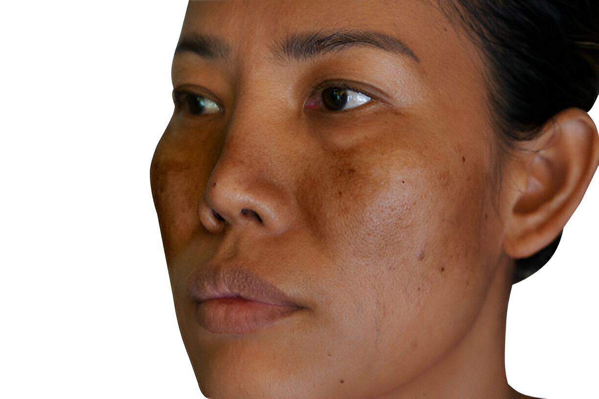 Skin Pigmentation