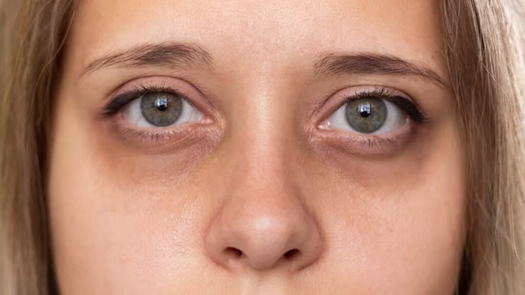 dark circles under eyes