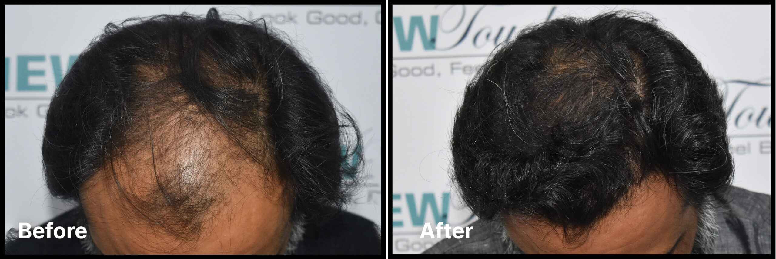 Advance Hair Implant (AHI) Process