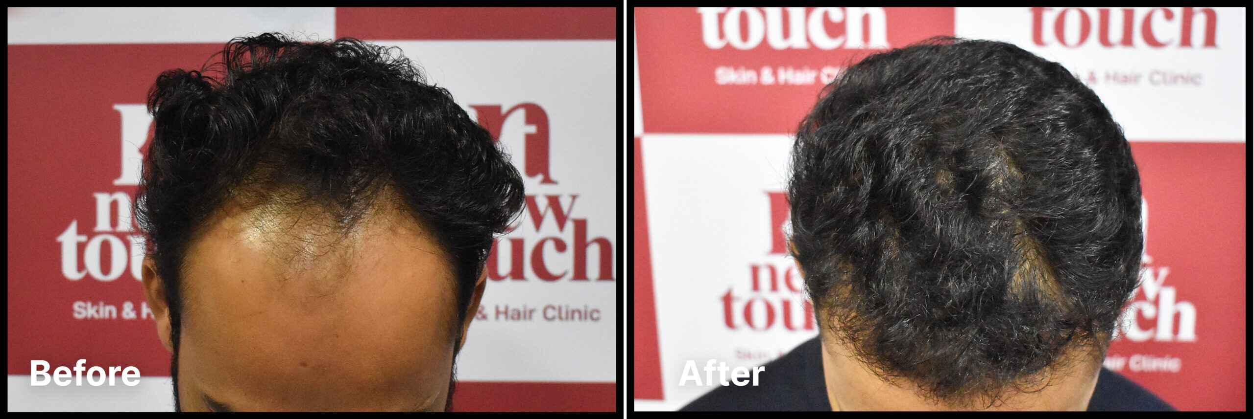 Advance Hair Implant (AHI) Process