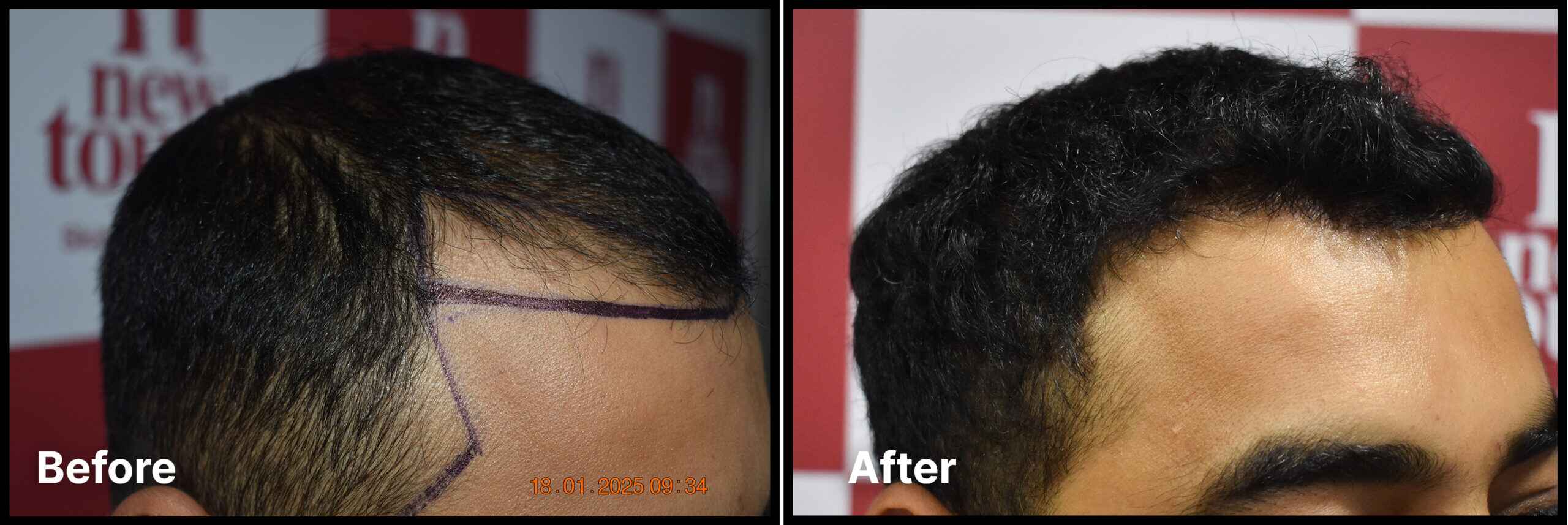 Advance Hair Implant (AHI) Process