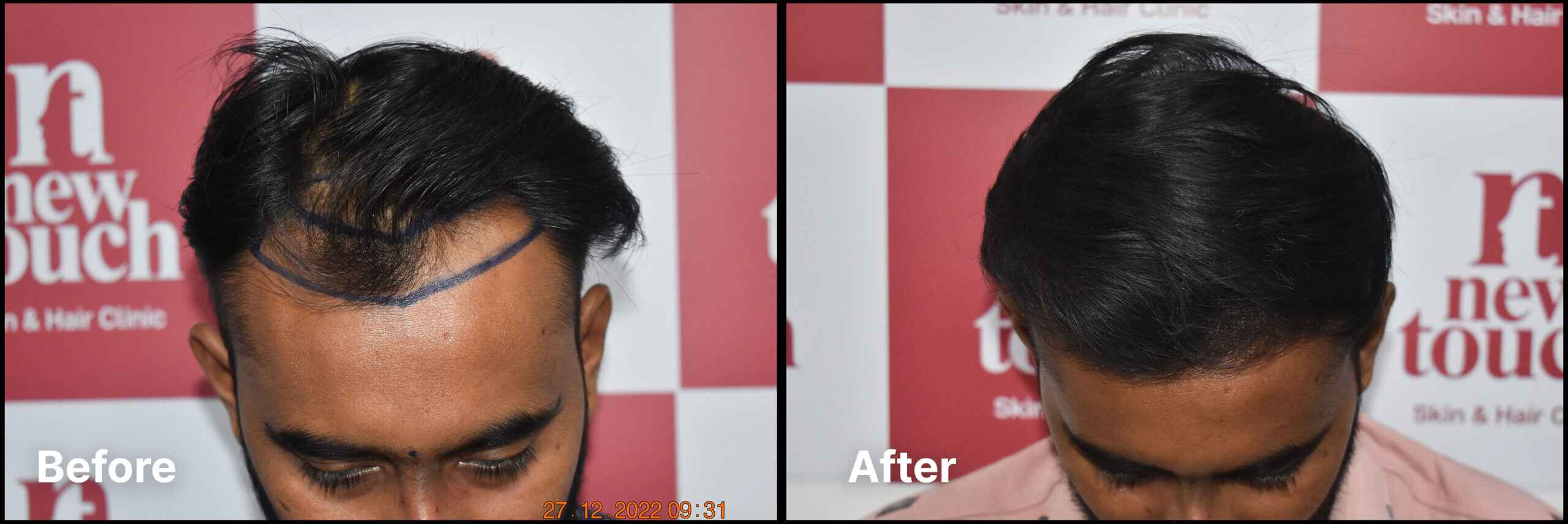 Advance Hair Implant (AHI) Process